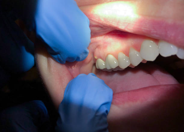 Best Emergency Treatment for Toothache in Montgomery, AL